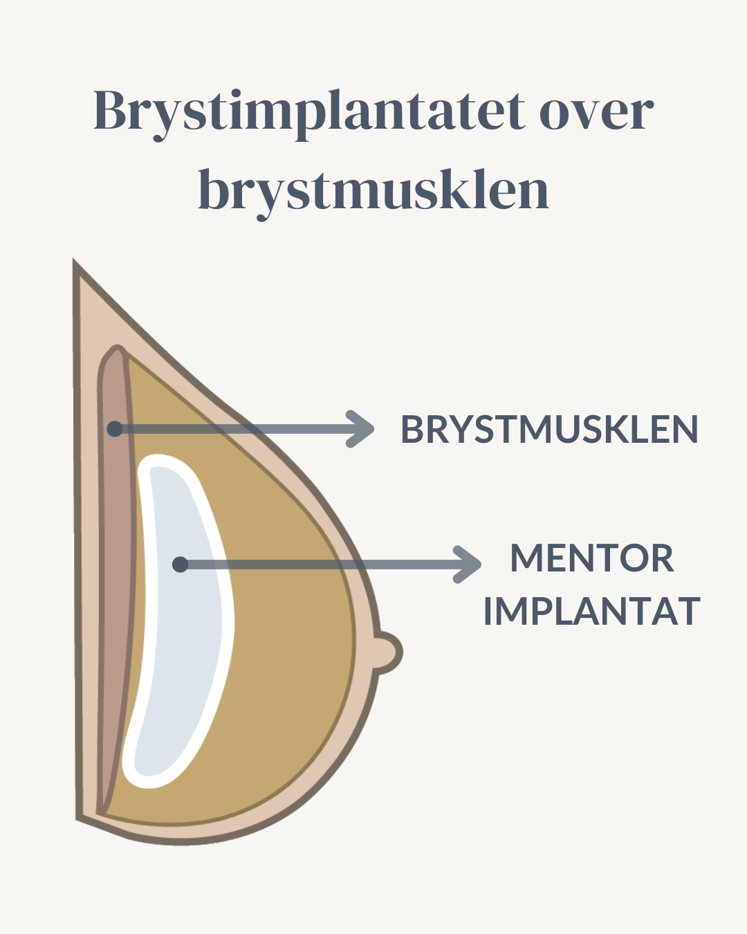 Illustration af brystoperation med implantat over brystmusklen hos Kongeporten.