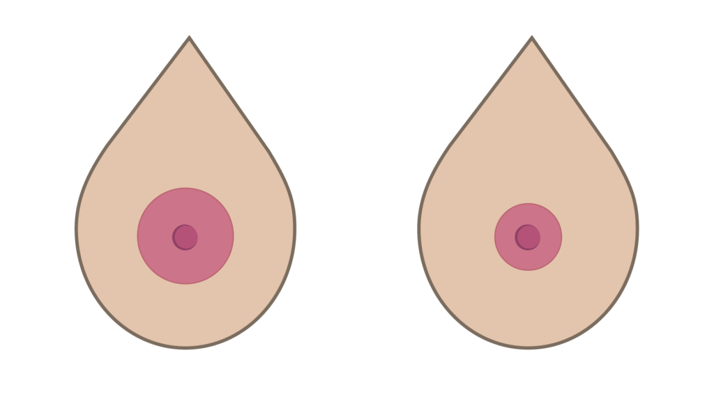 Illustration af til Brystvortereduktion Pigmentområdet hos Klinik Kongeporten.